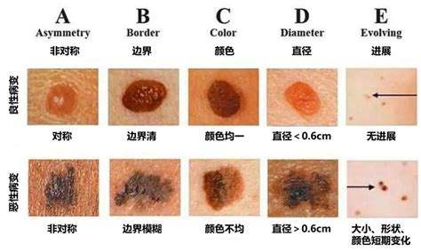 蛋蛋長痣|蛋蛋上长了好多黑痣说明什么